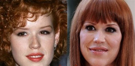 molly ringwald plastic surgery